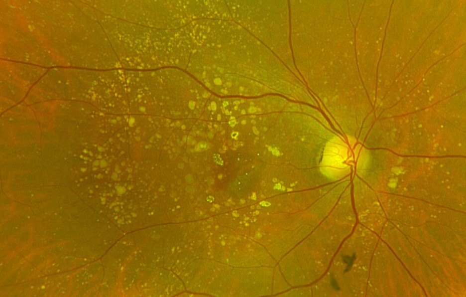 Revolutionary Dry Macular Degeneration Treatment Revolutionary dry macular degeneration treatment