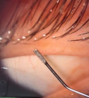 How Can Meibomian Gland Probing Help Dry Eye Care 